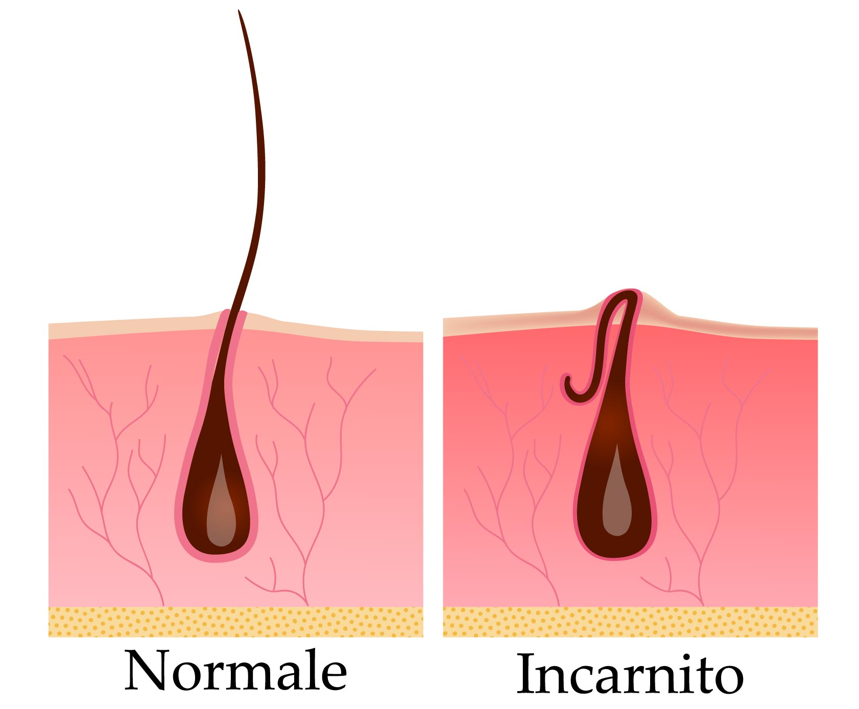 Ingrown hairs after brazilian